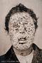 smallpox